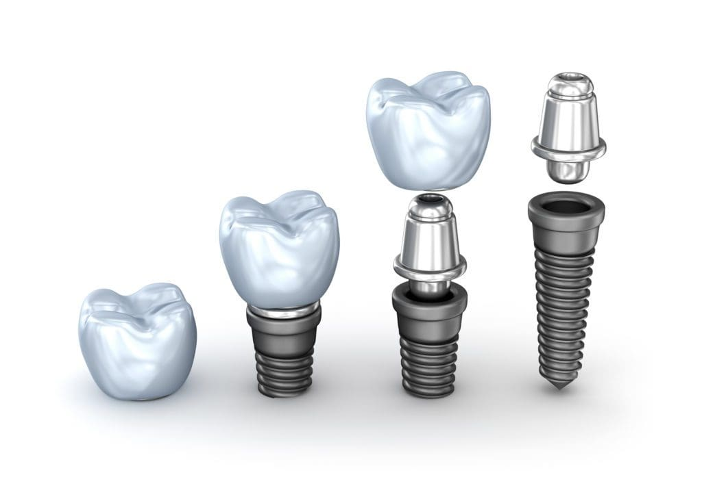 trong-rang-implant1-1740648033.png
