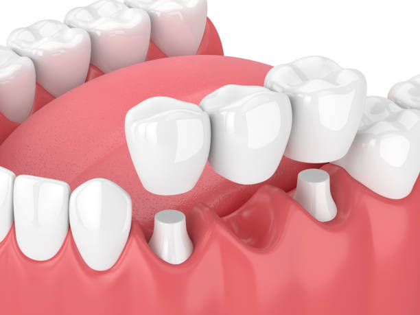 trong-rang-implant2-1740648033.png