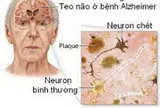 Phòng bệnh Alzheimer ở người lớn tuổi
