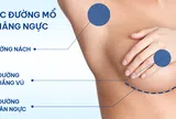 Lựa chọn đường mổ nâng ngực phù hợp cho phụ nữ Á Đông