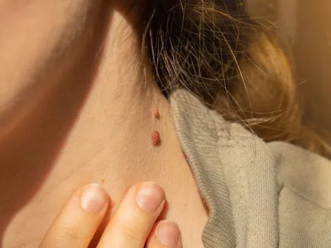 Mụn thịt - mối nguy tiềm ẩn hay chỉ là vấn đề thẩm mỹ?