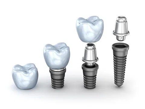 Trồng răng Implant và cầu răng sứ – Đâu là lựa chọn tốt nhất?