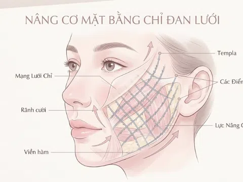 Bio Meshwork - Bước tiến mới trong kỹ thuật cân chỉnh lõm hóp và tái cấu trúc gương mặt toàn diện