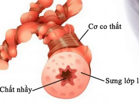Bệnh nhân hen suyễn nếu mắc COVID-19 sẽ rất nguy hiểm