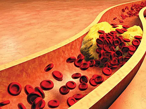 Tăng mỡ máu ở người cao tuổi