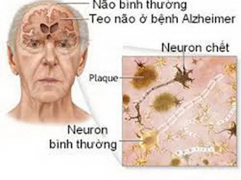 Phòng bệnh Alzheimer ở người lớn tuổi