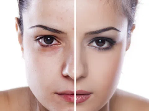 Nguyên nhân hình thành và phương pháp điều trị mụn trứng cá