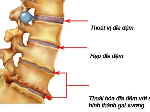 Thực phẩm bảo vệ sức khỏe Cốt Thoái Vương giúp nhiều người thoát khỏi đau lưng do gai đốt sống và thoát vị đĩa đệm