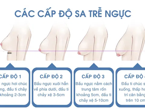 Lựa chọn tối ưu cho ngực sa trễ: Đặt túi hay không đặt túi?