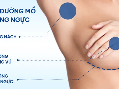 Lựa chọn đường mổ nâng ngực phù hợp cho phụ nữ Á Đông