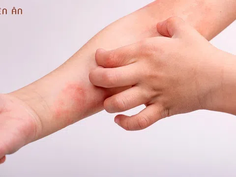 Bỏ túi bí quyết phục làm dịu và hồi da trong mùa hanh khô