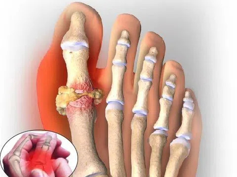 Bệnh gút có ăn Yến sào được không ? Bệnh gút nên ăn gì ?