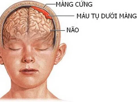 Máu tụ dưới màng cứng mạn tính ở người cao tuổi